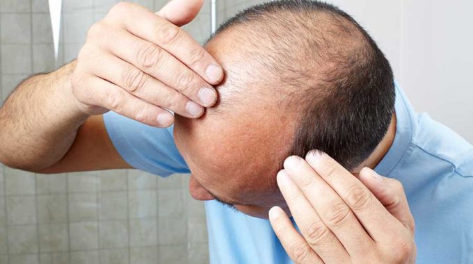 El Estrés Y La Pérdida De Cabello