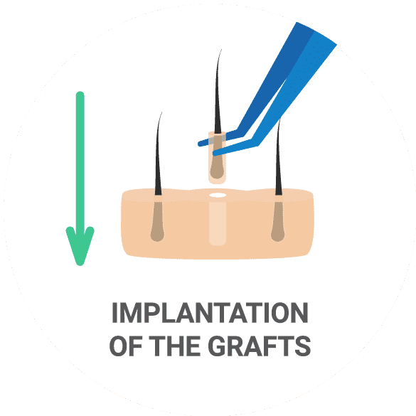 Implante de cabello por método FUE